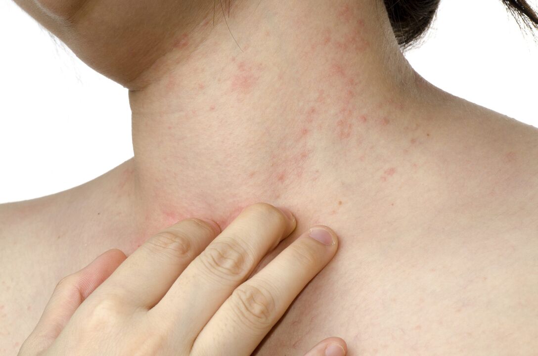 荨麻疹是皮下寄生虫的症状